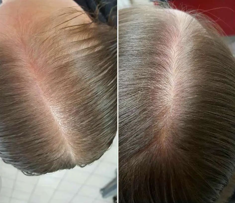 cause caduta capelli nelle donne